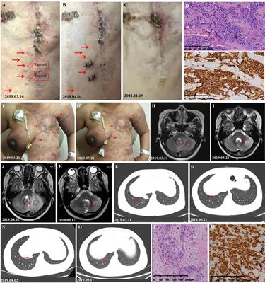 Case Report: Significant Efficacy of Pyrotinib in the Treatment of Extensive Human Epidermal Growth Factor Receptor 2-Positive Breast Cancer Cutaneous Metastases: A Report of Five Cases